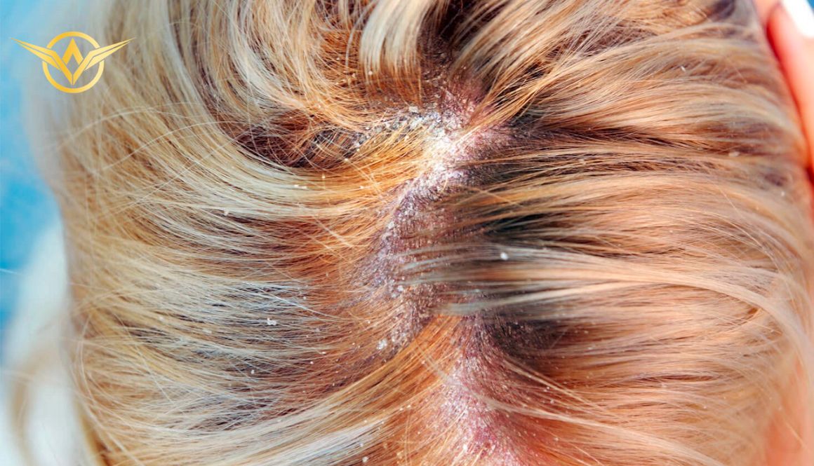 Nấm da đầu rất dễ gây rụng tóc, bong tróc, hói đầu, chảy máu gây cho người bệnh vô cùng khó chịu
