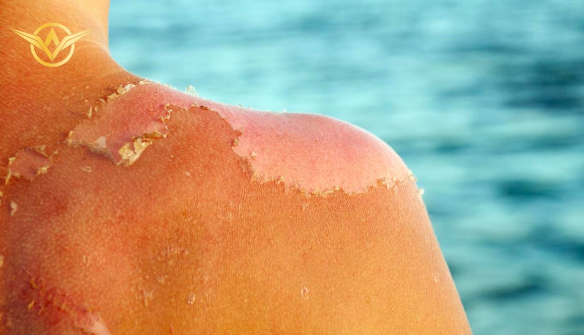 Các tổn thương do ánh nắng mặt trời gây ra như cháy nắng, viêm nhiễm, mẩn đỏ và ngứa có thể thuyên giảm bằng cách thoa nước vo gạo chứa tinh bột.