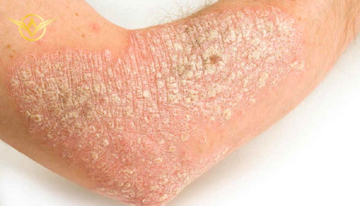 4-47 Các bệnh da liễu thường gặp ở nam giới là vảy nến, một tình trạng viêm da mãn tính phổ biến