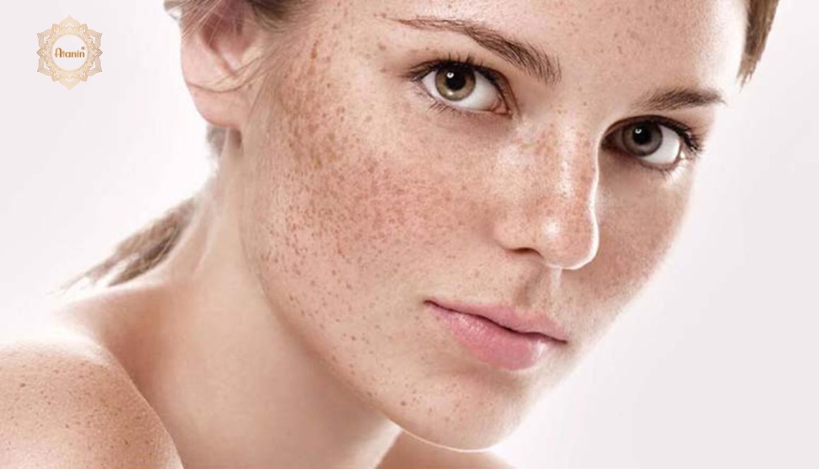 Nám da là việc tăng sắc tố ở một số vùng da nhất định sẽ hình thình những đốm đen trên da