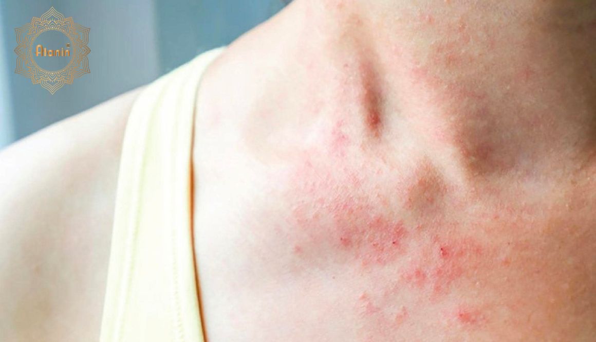 Tinh dầu thông đỏ khử khuẩn có thể điều trị một số bệnh về da