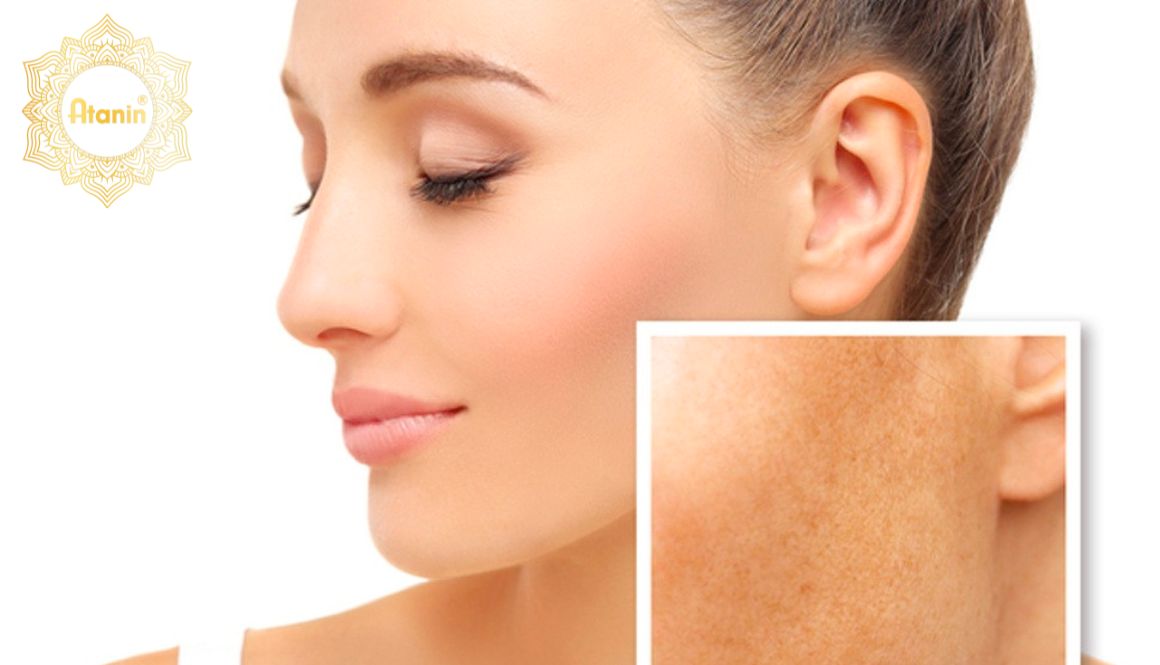 Nguyên nhân được coi là phổ biến khiến cho da bị nám đầu tiên phải kể tới do rối loạn sắc tố melanin