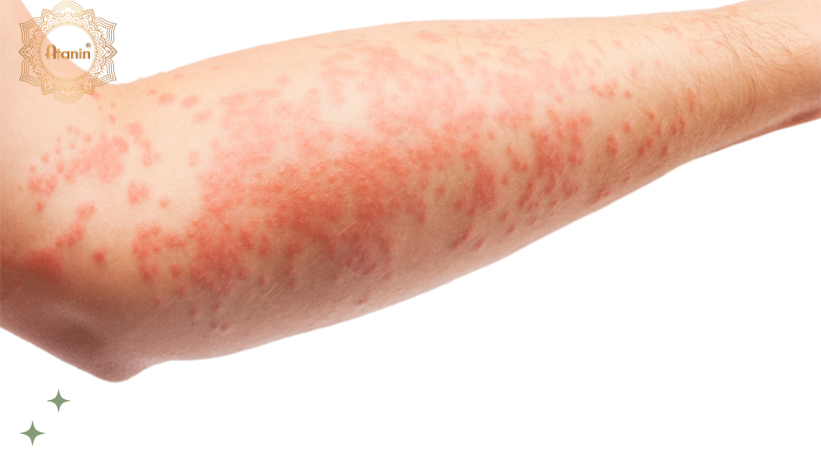 Nổi nốt đỏ trên da và ngứa – Nguyên nhân và khắc phục
