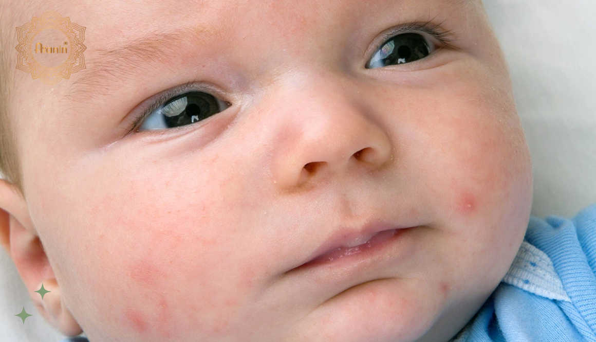 3 bệnh về da ở trẻ sơ sinh mà mẹ bỉm cần biết