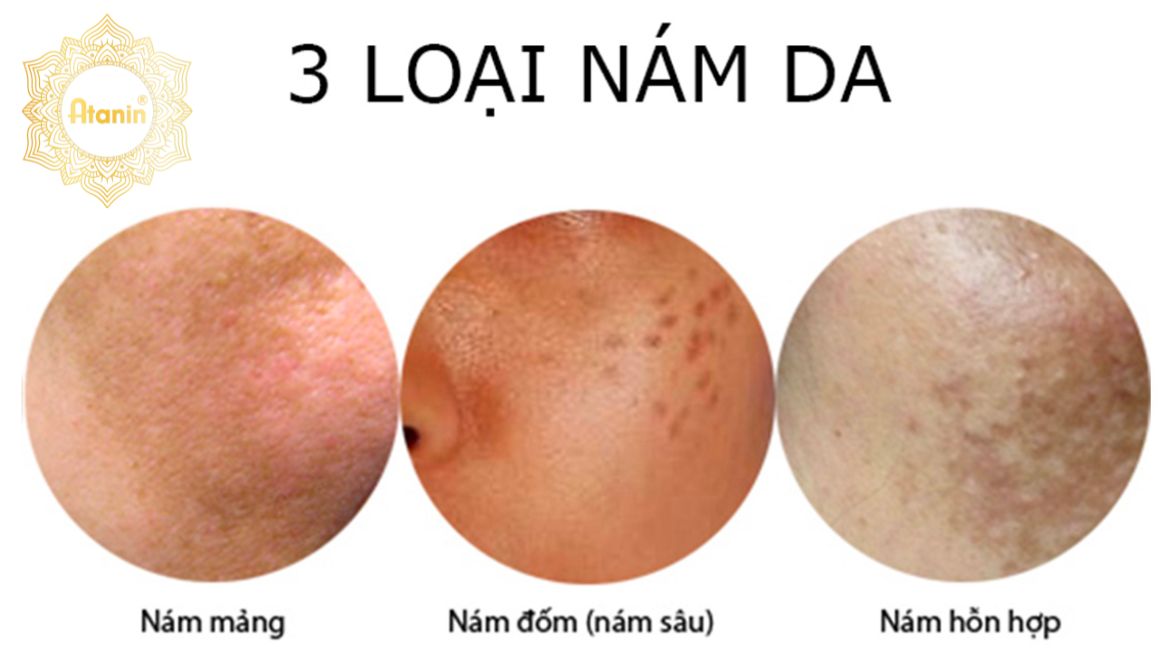 Các loại nám da phổ biến là do rối loạn sắc tố da thường gặp, xuất hiện khi tế bào melanin phát triển quá mức