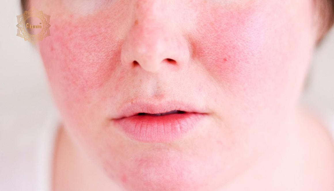 Các vết đỏ dị ứng, nổi mề đay mẩn ngứa và biểu hiện gồ lên trên bề mặt da