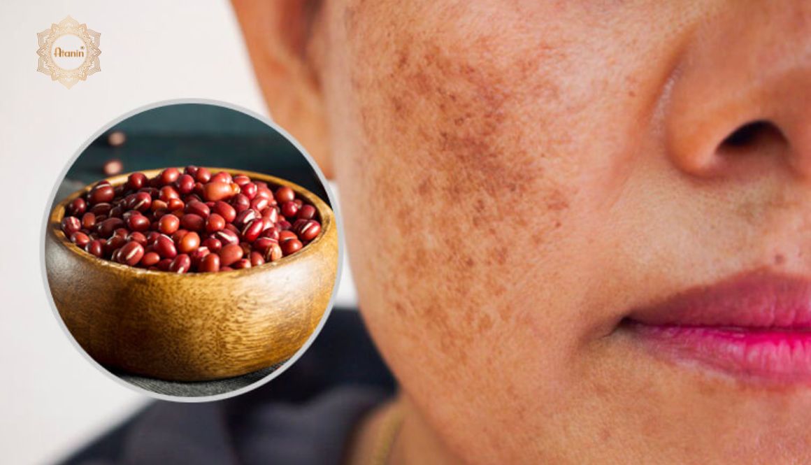 Giàu chất chống oxy hóa, đậu lăng đỏ cũng có thể điều trị chứng tăng sắc tố da do nám