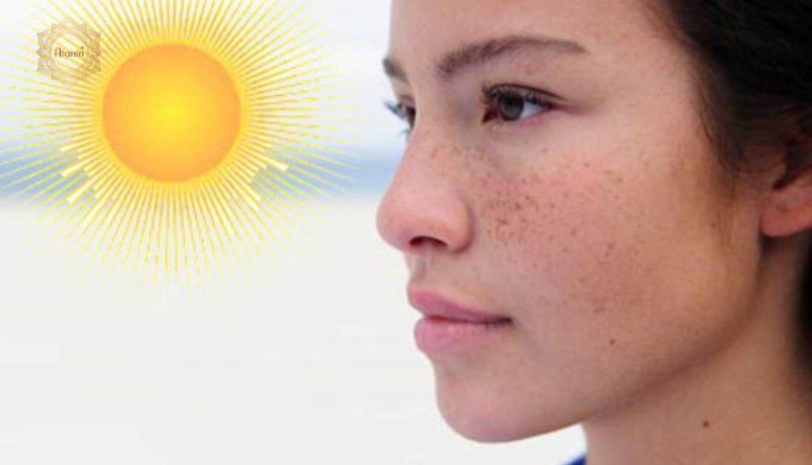 Nguyên nhân gây nám tàn nhang có thể là do tiếp xúc trực tiếp dưới ánh nắng mặt trời